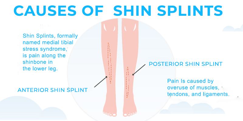 Causes Shin Splints