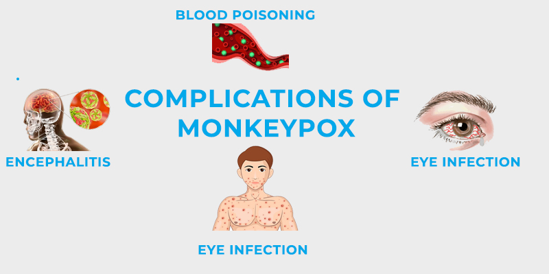 Complications Of Monkeypox: