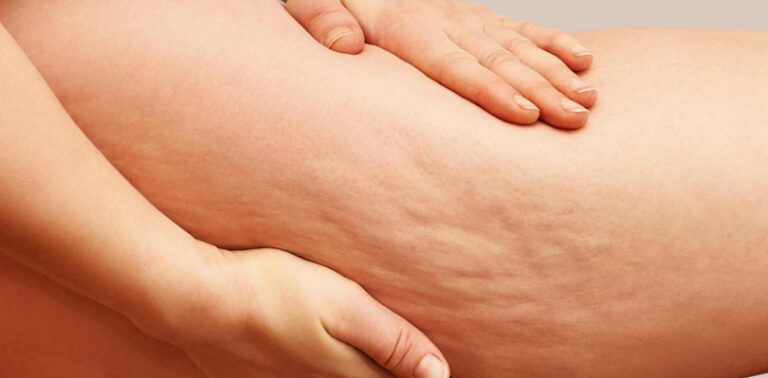 How To Cure Cellulite: Exercise, Treatments, And More