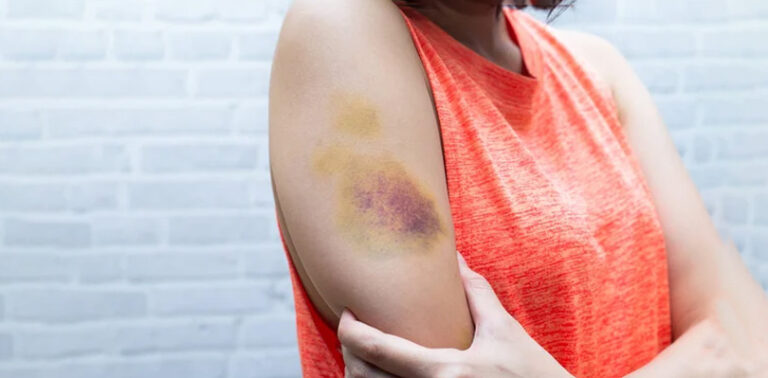 How To Cure Hematoma: Care Instructions, Symptoms, And More