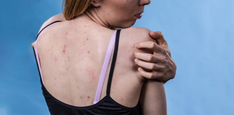 6 Amazing Treatments For Keratosis Pilaris: You Should Know