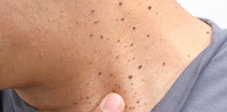 How To Remove Skin Tag: Tips, Treatments, And More