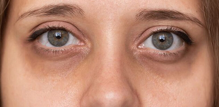 Dark Circles Under The Eyes: Causes And Proven Home Remedies