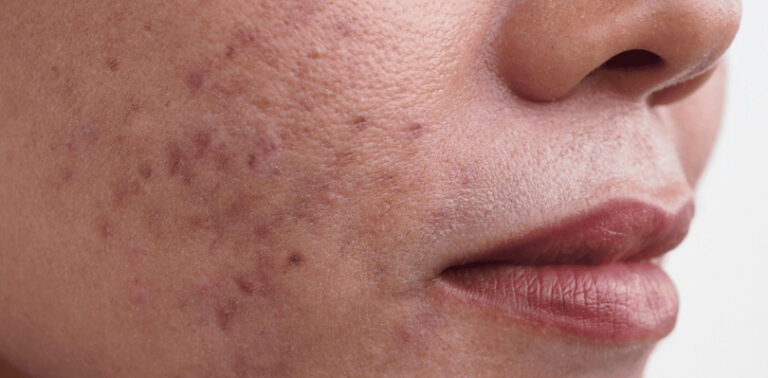 Skin Concerns: Targeting Hyperpigmentation, Acne, And Redness