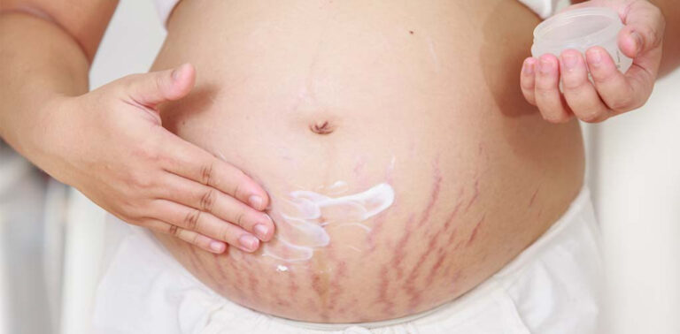 How To Reduce Stretch Marks Naturally? 10 Proven Remedies