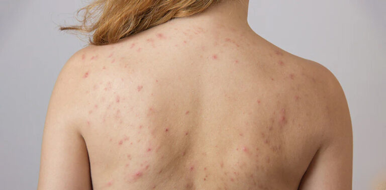 Common Myths About Acne You Should Avoid