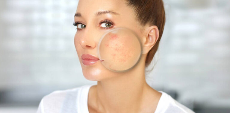 How To Remove Acne Scars? Effective Natural Remedies To Consider