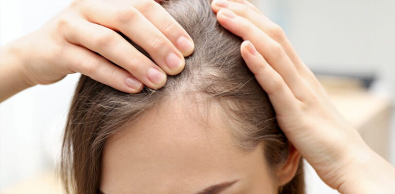 How To Cure Alopecia, Causes And Symptoms: Learn More