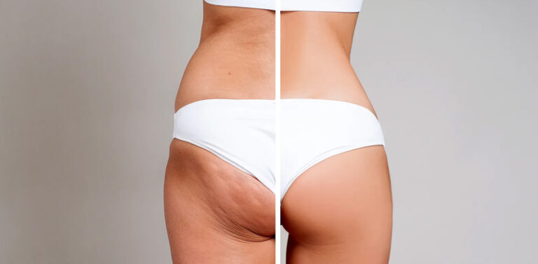 Effective Cellulite Treatments For Everyone