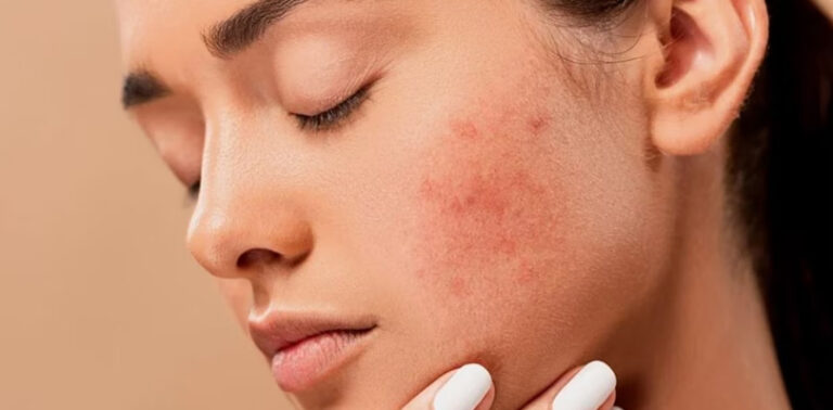 Proven Home Remedies For Facial Scars You Must Try